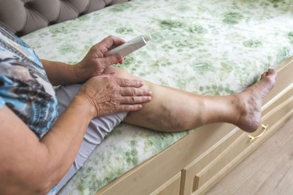 Picioare dureroase varice – Medicină și sănătate