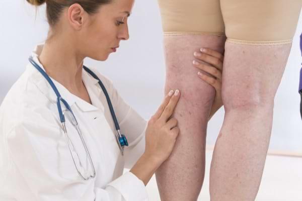 Remedii populare pentru blocarea venelor pe picioare