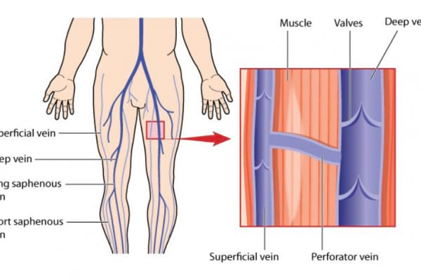 bysption de picioare în venele varicoase dupa operaie