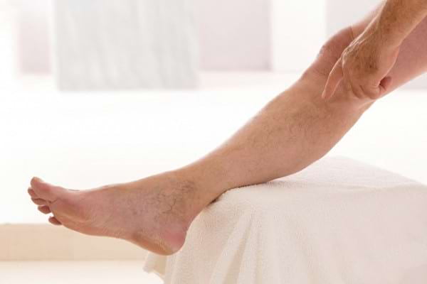 tratamentul eficient al picioarelor varicoase