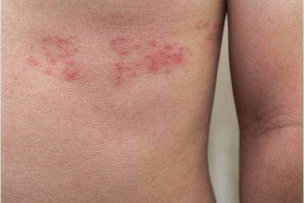 herpes zona zoster