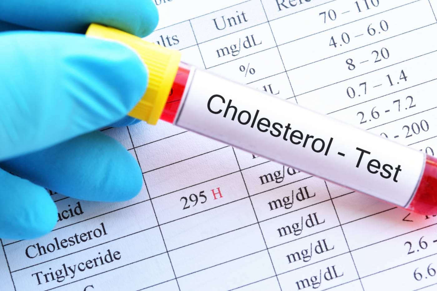 Varicoză varicoză colesterol, Cauze pentru varice