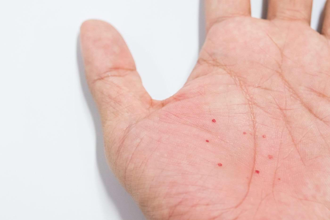 Eczema la degete