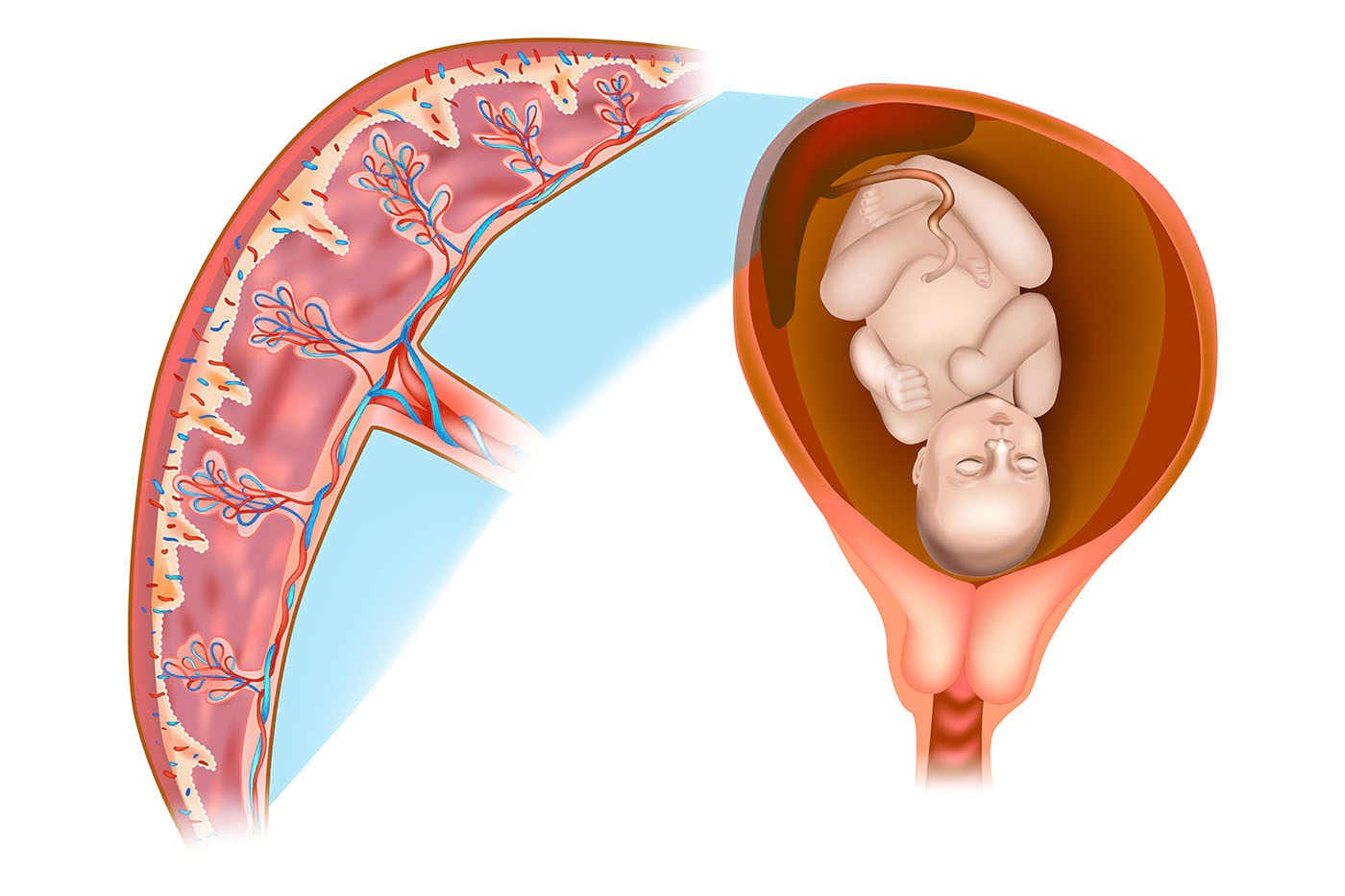 DESPRE FIBROMUL UTERIN Sângerări uterine și varicoză