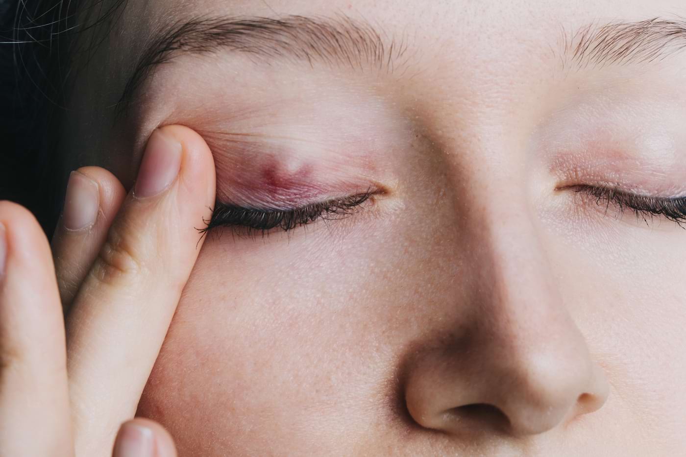 Ulcior la ochi – cauze, simptome și tratament