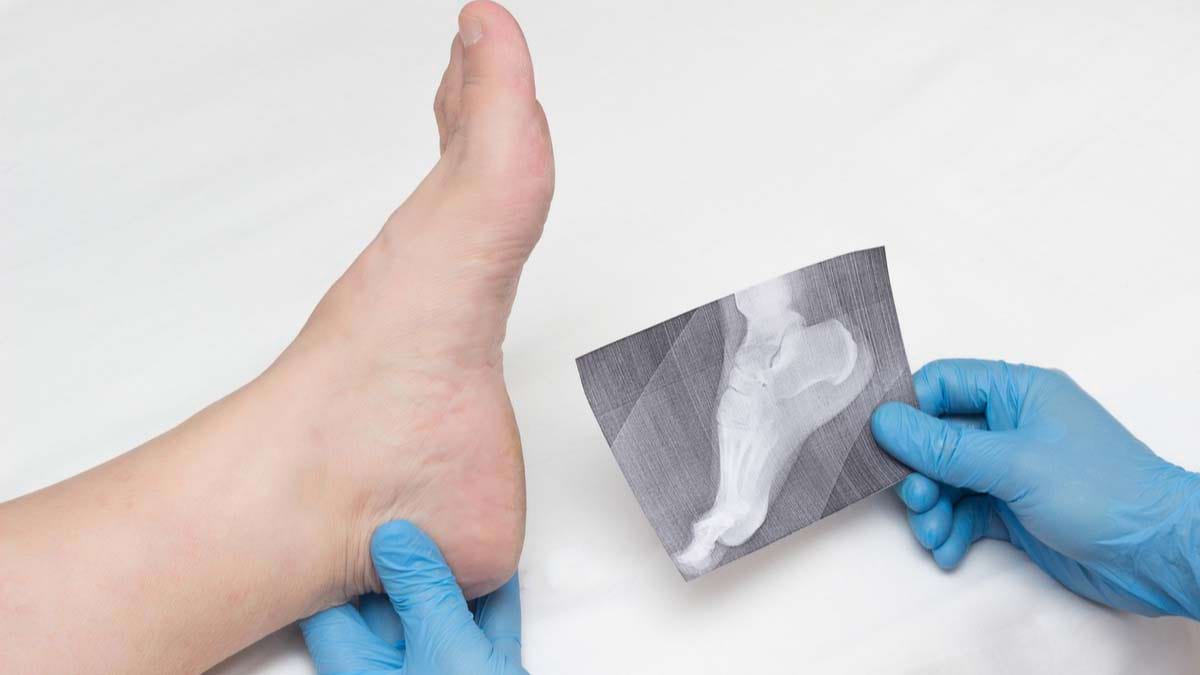 tratamentul osteofitelor coloanei toracice durere severă internă a genunchiului