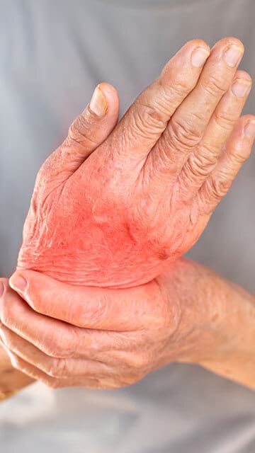 Artrita reumatoida arzand mainile si picioarele - Selectbistrita