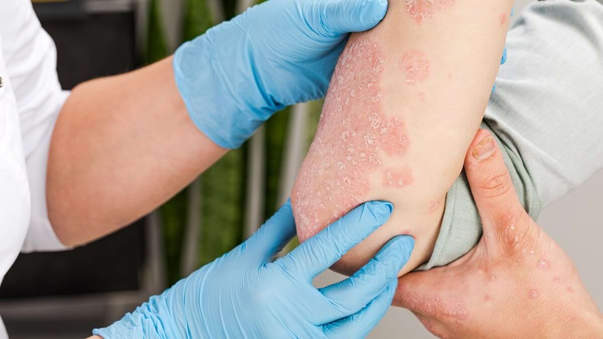 Despre artrita psoriazică