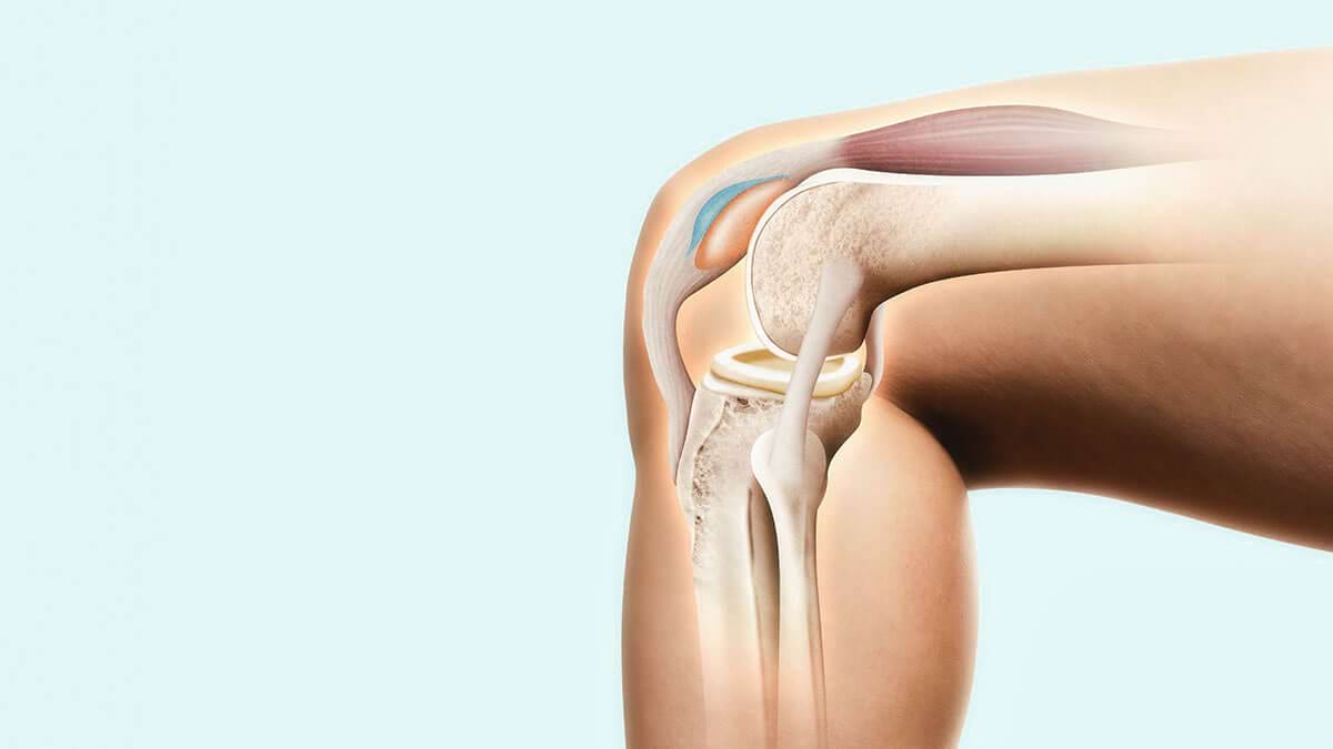 tratamentul mușchilor picioarelor cu artroză articulară cum să identificați artroza cotului