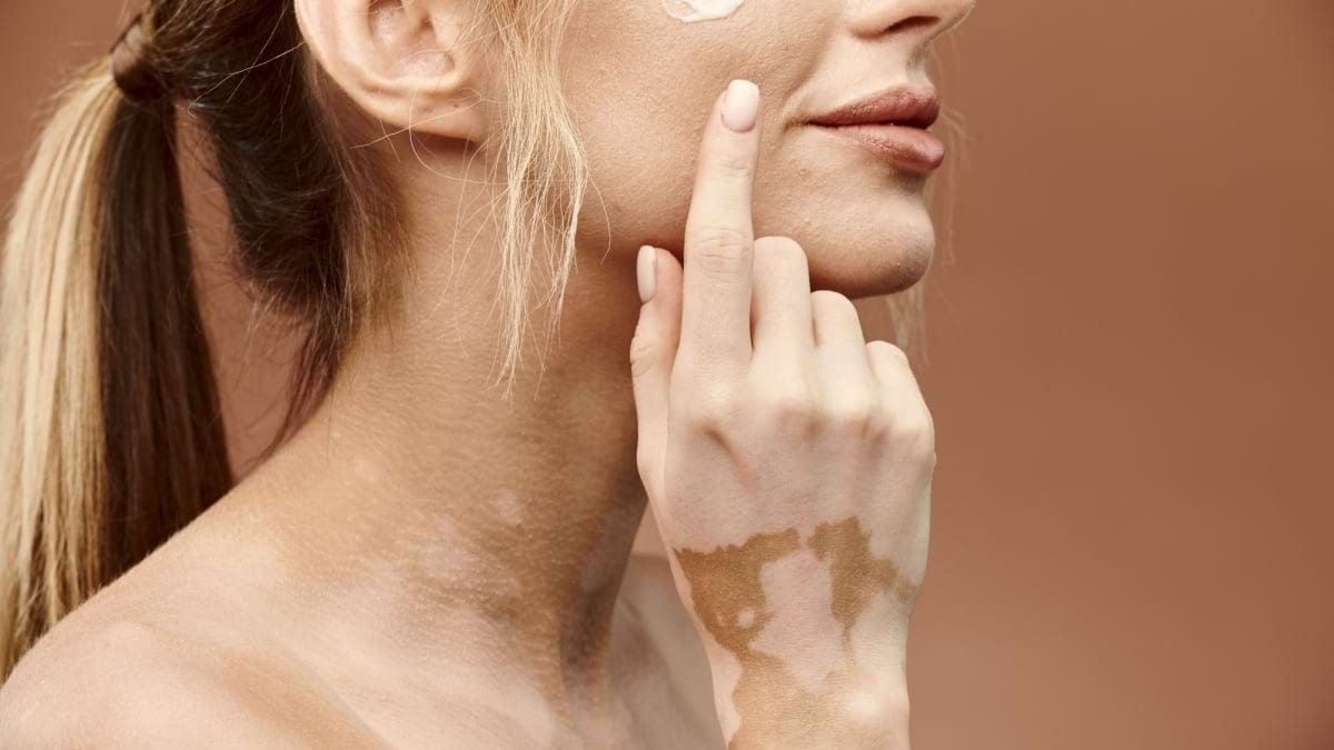 Cu vitiligo la plaja – cum iti protejezi pielea