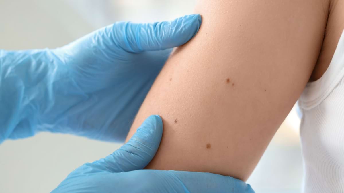 Metastazele in cancerul de piele