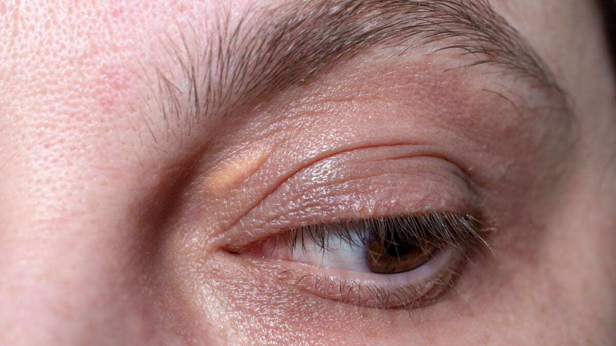 Xantoamele: cauze, diagnostic si tratament