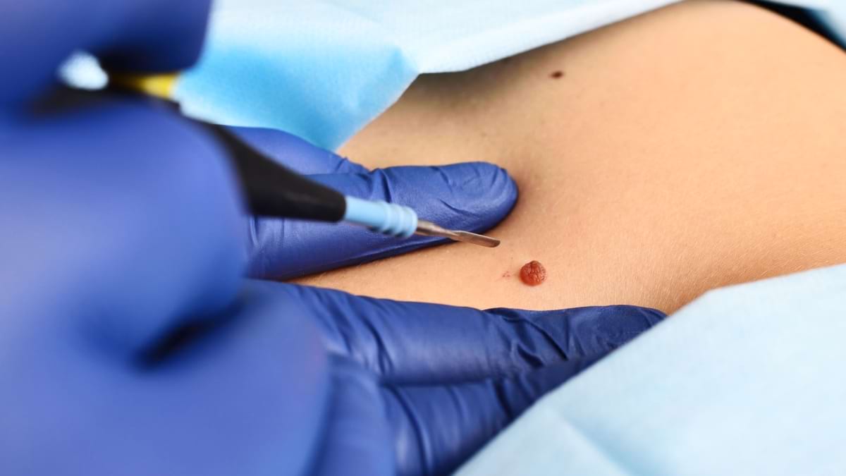 Utilizarea secventierii genomice in managementul melanomului malign