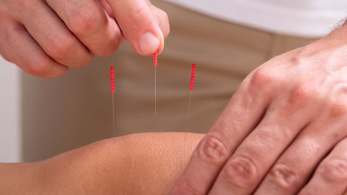 Acupunctura, o optiune viabila in tratamentul gonartrozei