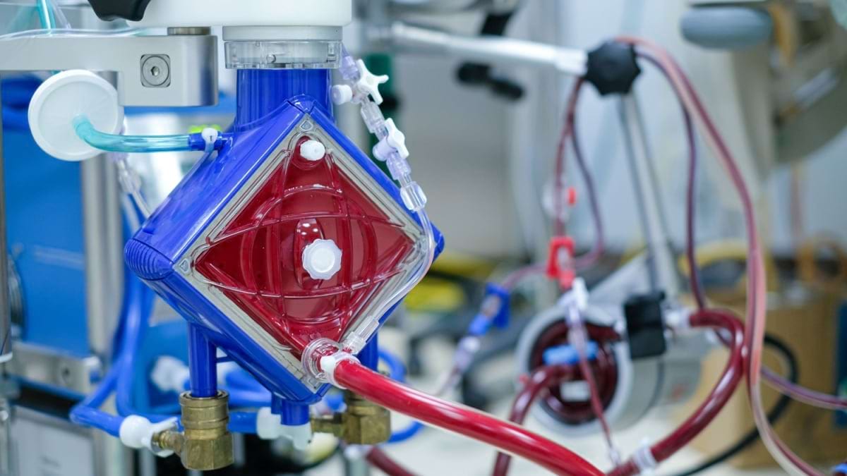 ECMO, procedura care poate salva viețile pacienților cu insuficiență respiratorie sau cardiacă