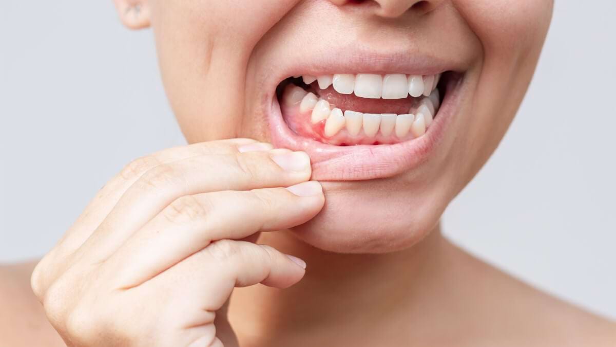 Modificarile gingiei: ce afectiuni poate indica o gingie inflamata?