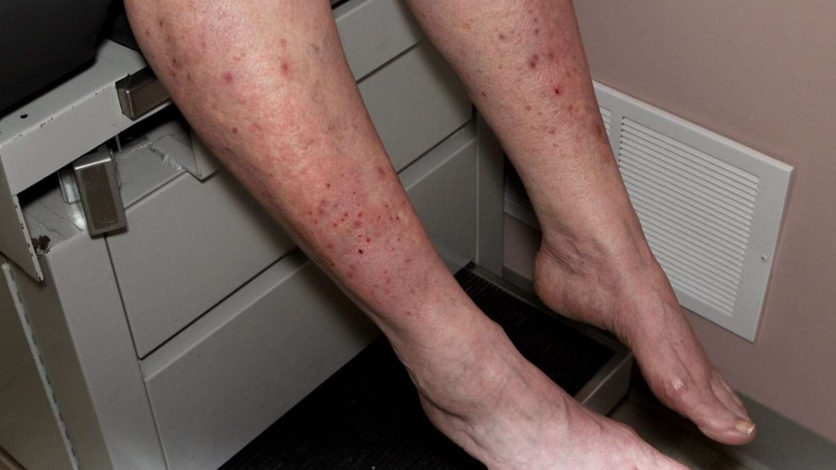 Dermatita herpetiformă: cauze, simptome, tratament