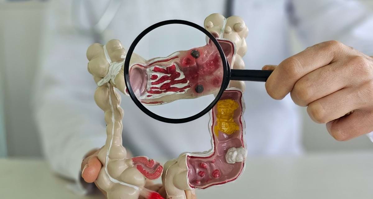 Există o legătură între consumul de alcool și cancerul de colon?
