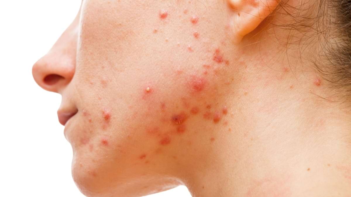 Acneea suprainfectată cu stafilococ auriu și streptococ