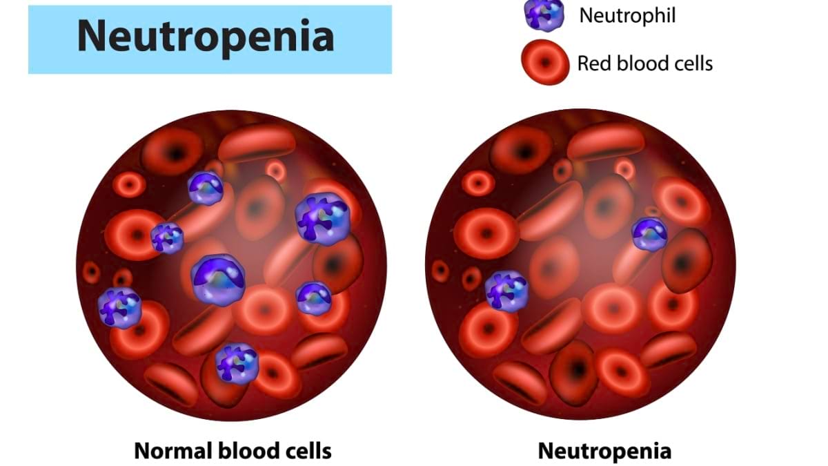 Ce este neutropenia cronică?