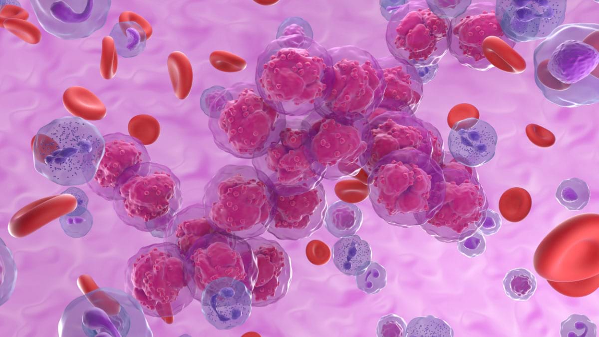 Leucemia limfoblastică acută la adulți