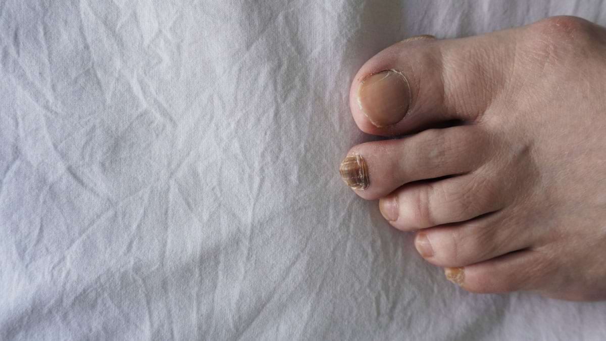 Melanomul lentiginos acral