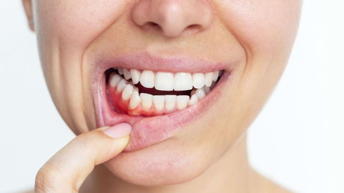 Nu ignora sângerarea gingiilor! Iată de ce