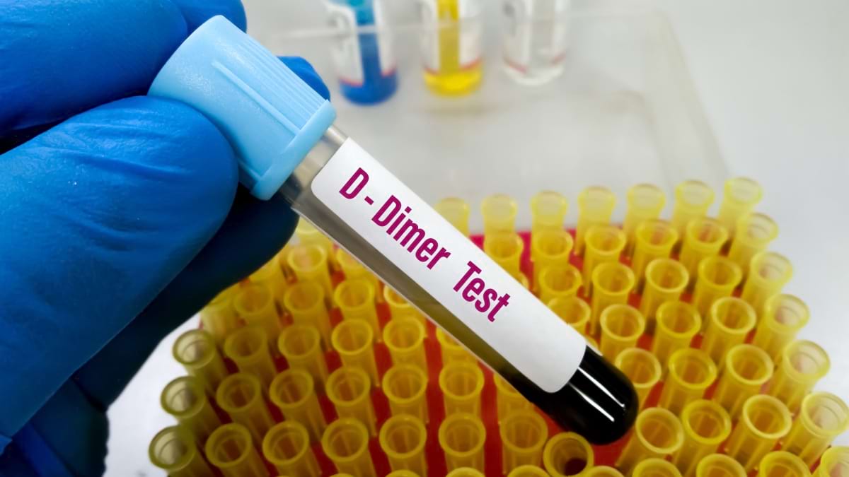 Sindromul de coagulare intravasculară diseminată
