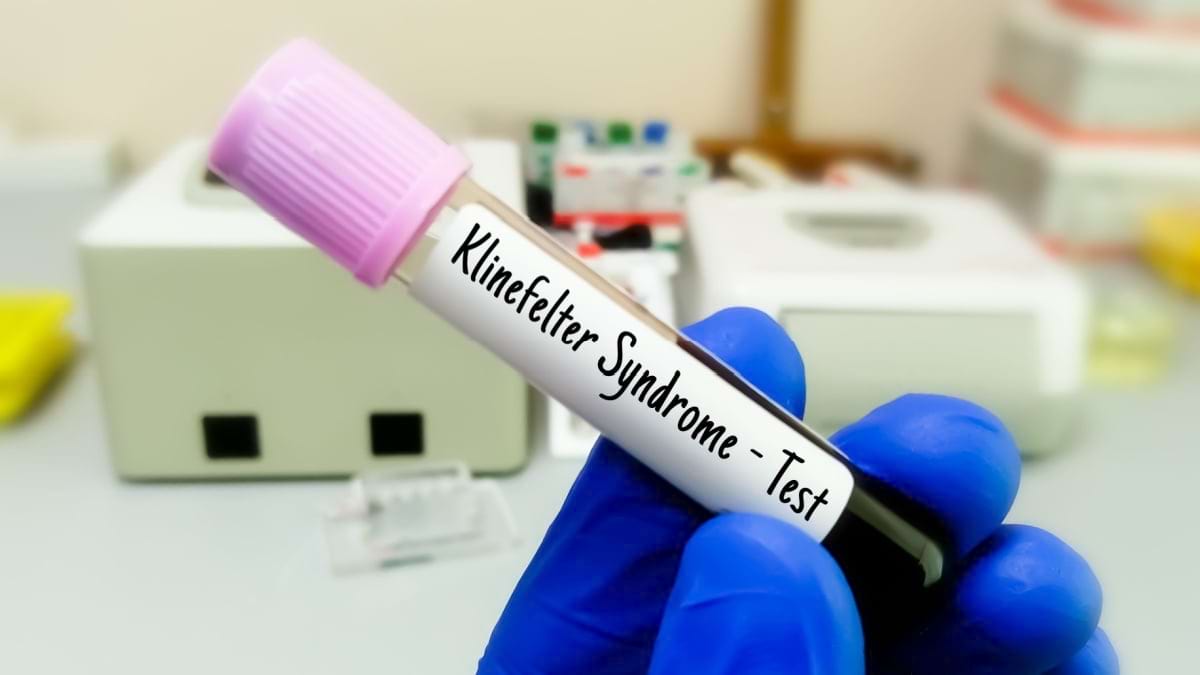 Ce este sindromul Klinefelter (XXY)?