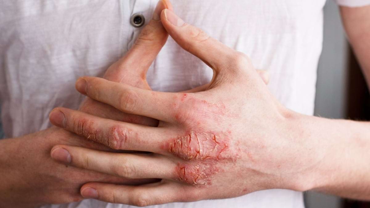Pericolul infecțiilor în dermatita atopică