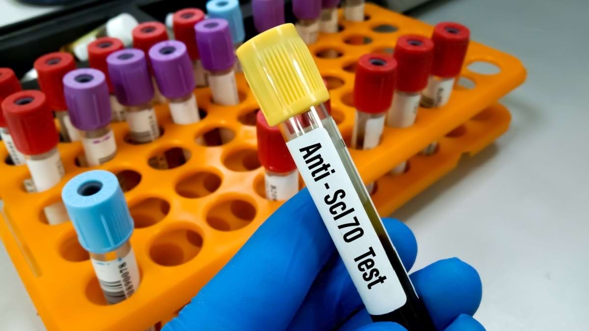 Riscul de cancer în sclerodermie (scleroza sistemică)