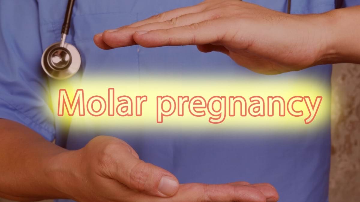 Sarcina molară (Mola hidatiforma): cauze, simptome, tratament