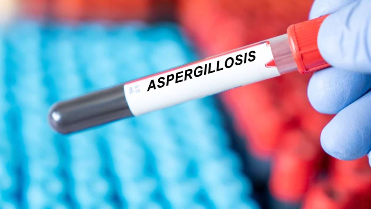Aspergiloza: cauze, simptome, diagnostic și tratament