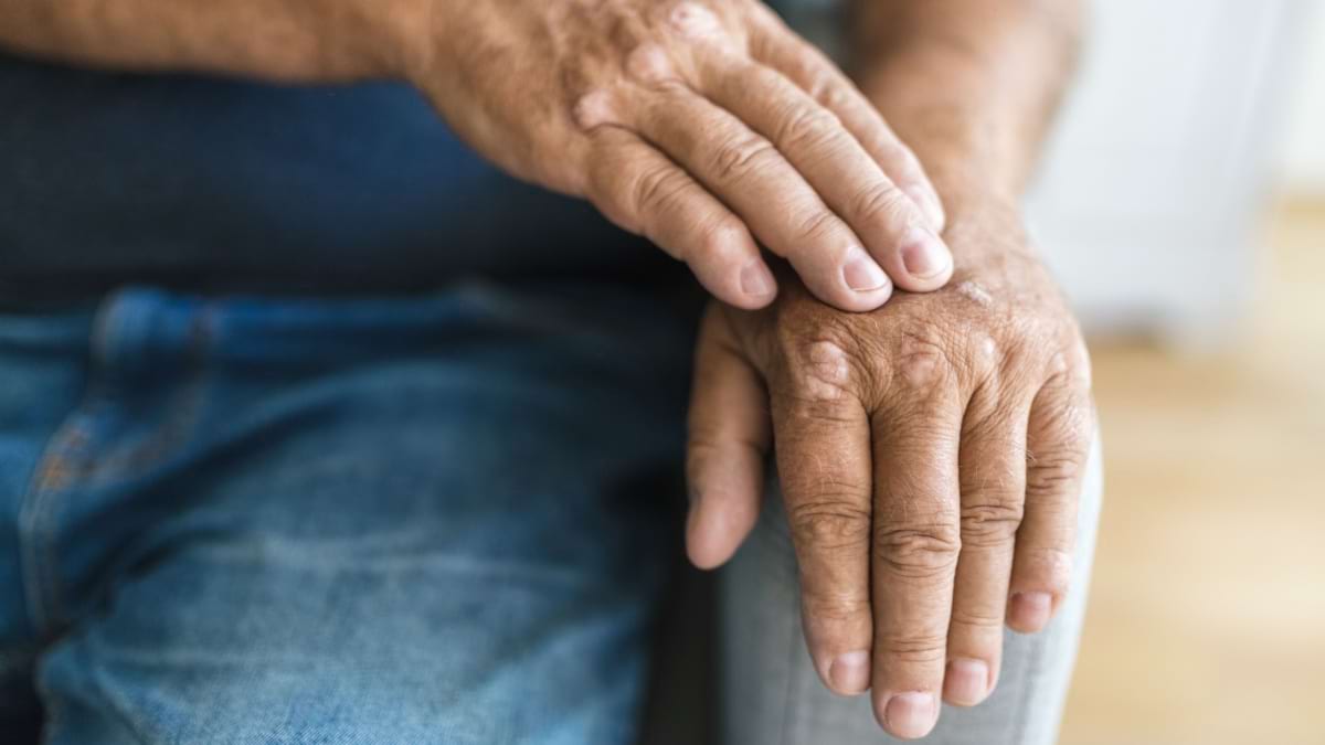 Ce faci când nu mai funcționează tratamentul pentru artrita psoriazică?
