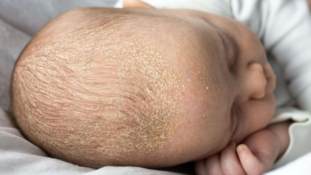 Dermatita seboreică a sugarului - ce tratamente dau rapid rezultate