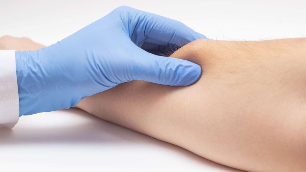 Totul despre lipoame: localizare, cauze, tratament