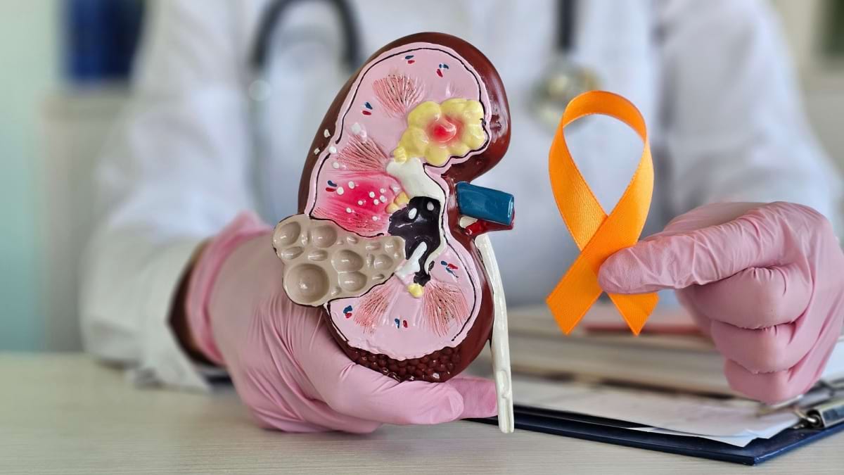 Totul despre carcinomul renal și tratamentul cu axitinib