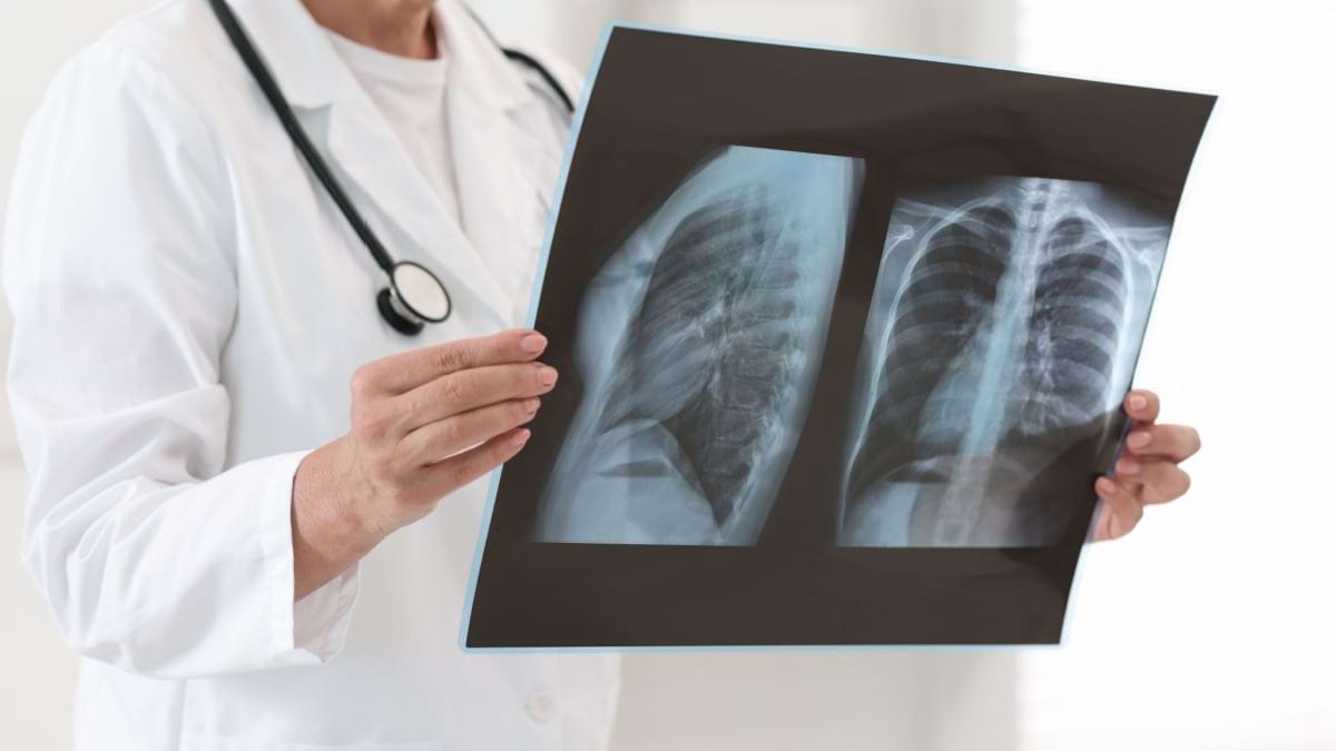 Complicatii ale cancerului la plamani