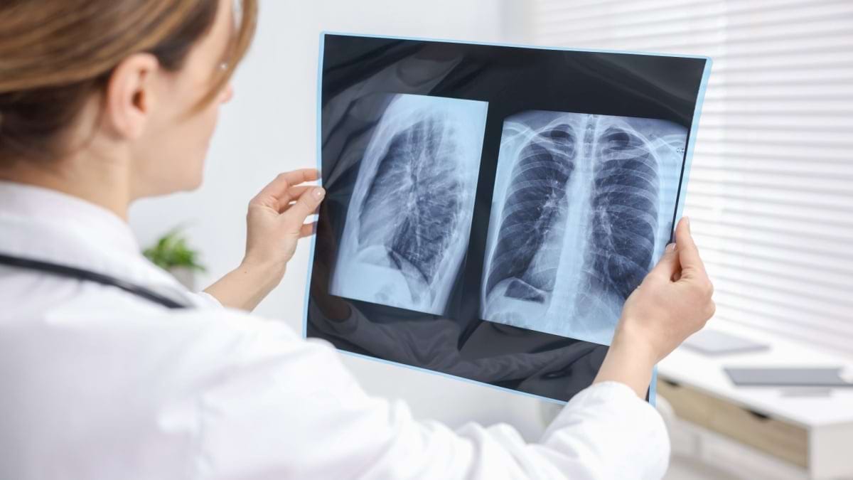 Terapia de primă linie în cancer pulmonar