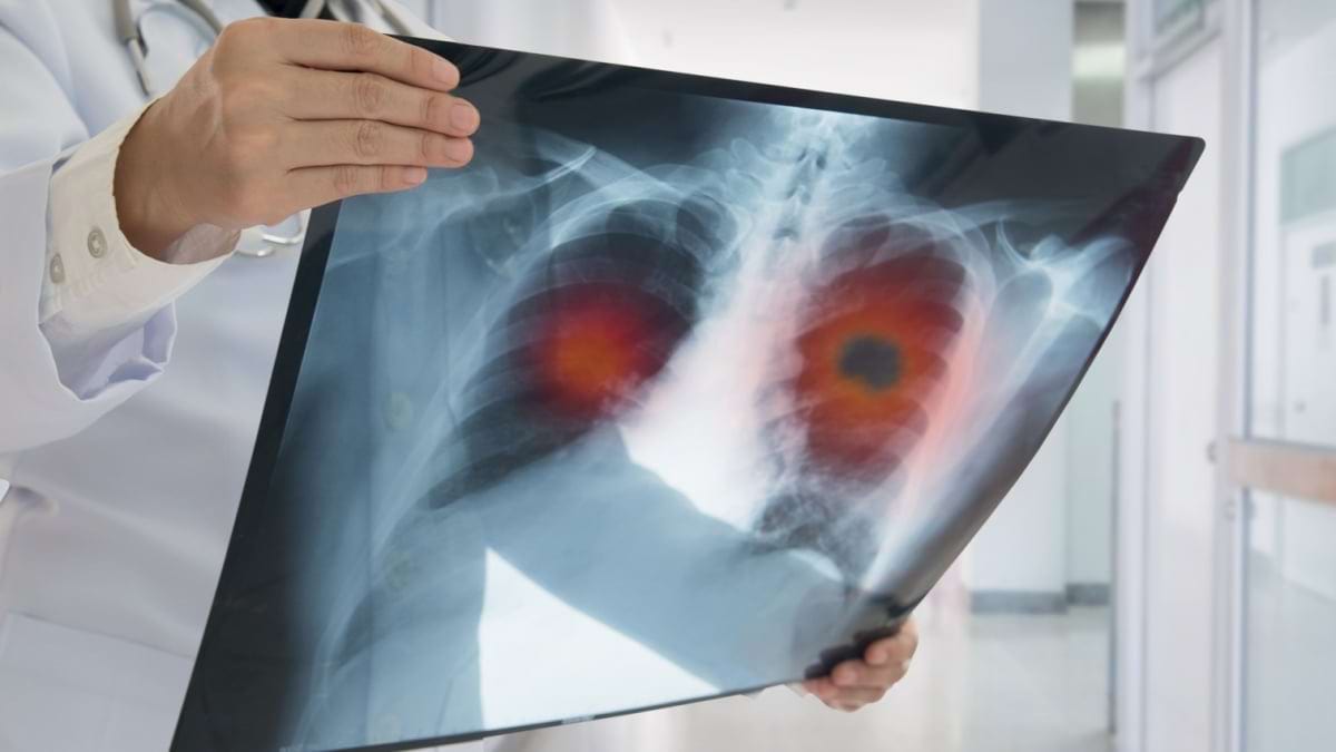 Cancerul pulmonar la nefumători: cauze, diagnostic și opțiuni de tratament