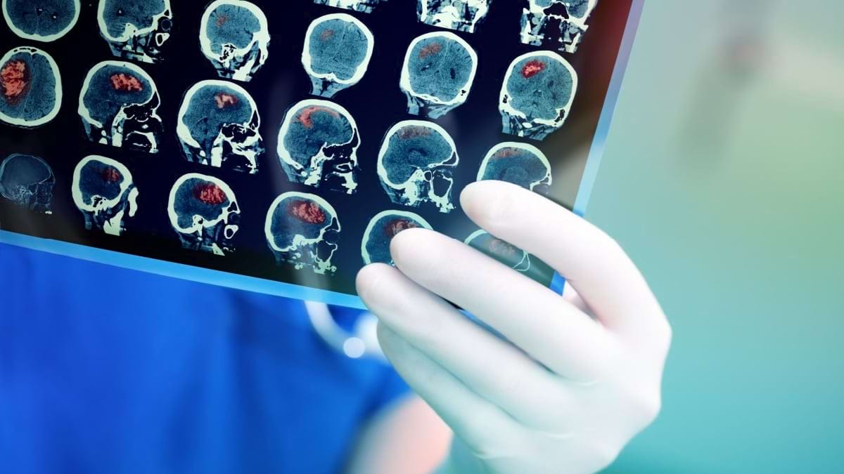 Diferențe între un accident vascular cerebral ischemic și unul hemoragic