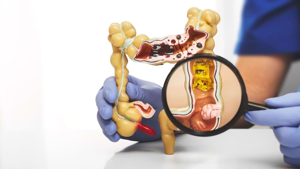 Localizarea cancerului de colon va influenţa atitudinea terapeutică?