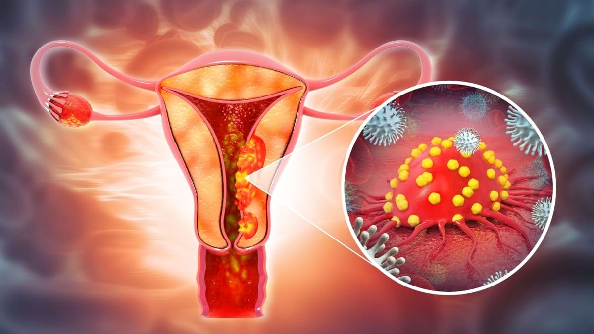 Opțiuni de tratament pentru cancer endometrial: intervenție chirurgicală, radioterapie, chimioterapie, terapie hormonală