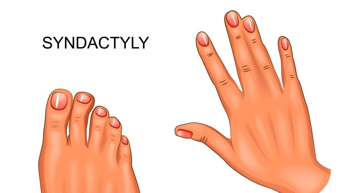 Sindactilie: cauze, simptome, diagnosticare, tratament