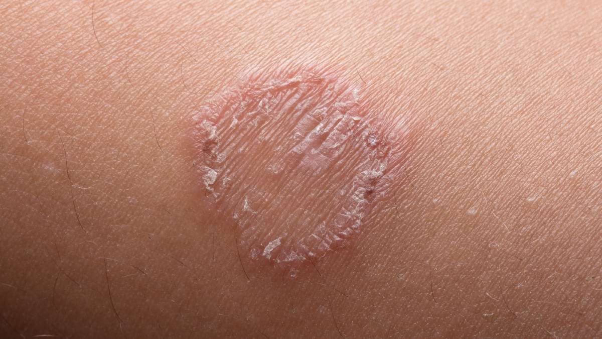 Pecingine: cauze, simptome, diagnostic și tratament