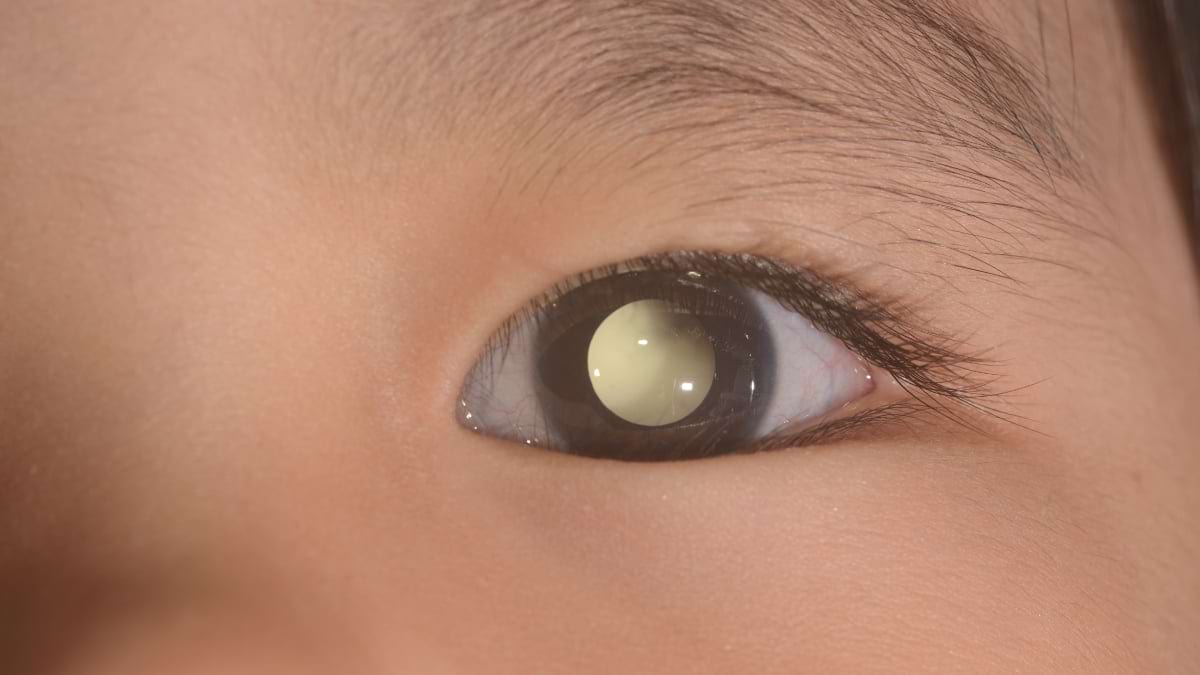Totul despre retinoblastom: cauze, simptome, tratament
