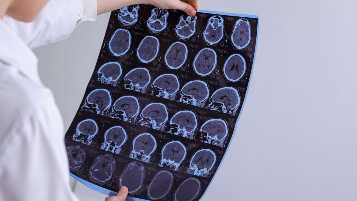 Leziuni demielinizante: cauze, simptome diagnostic
