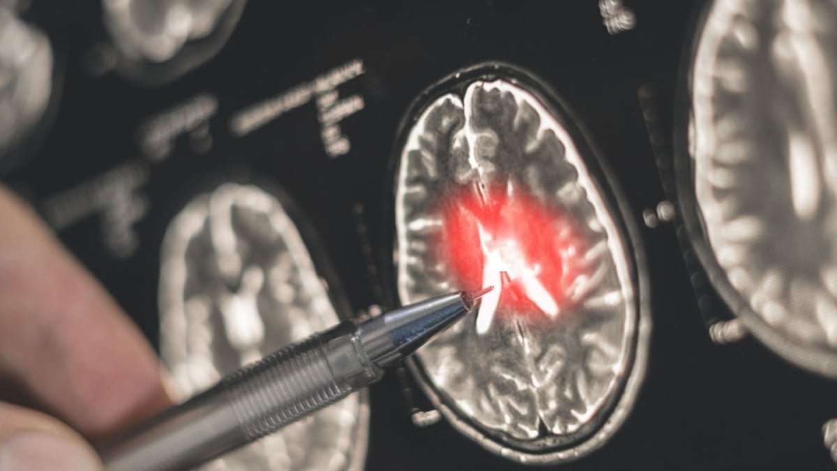 Mutatiile genetice ar putea sa accelereze boala Alzheimer