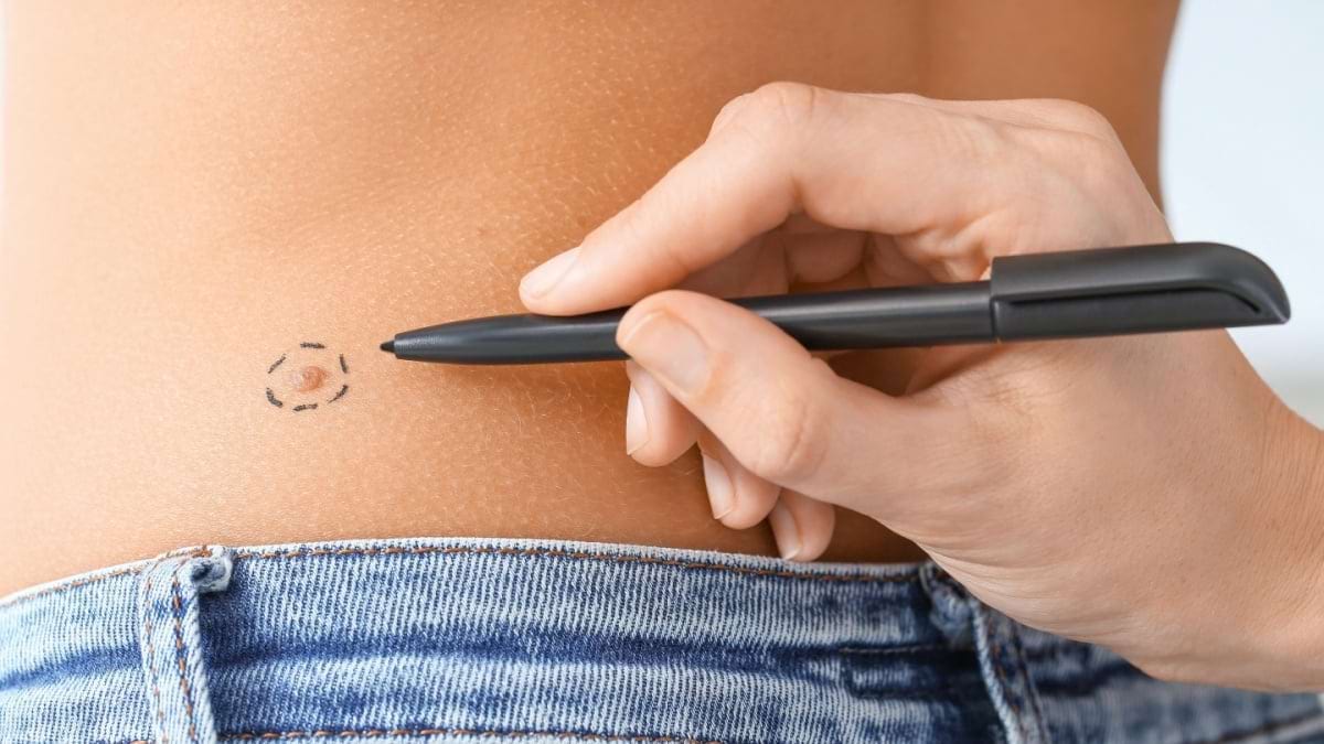 Instruirea cuplurilor face mai usoara depistarea cancerului de piele