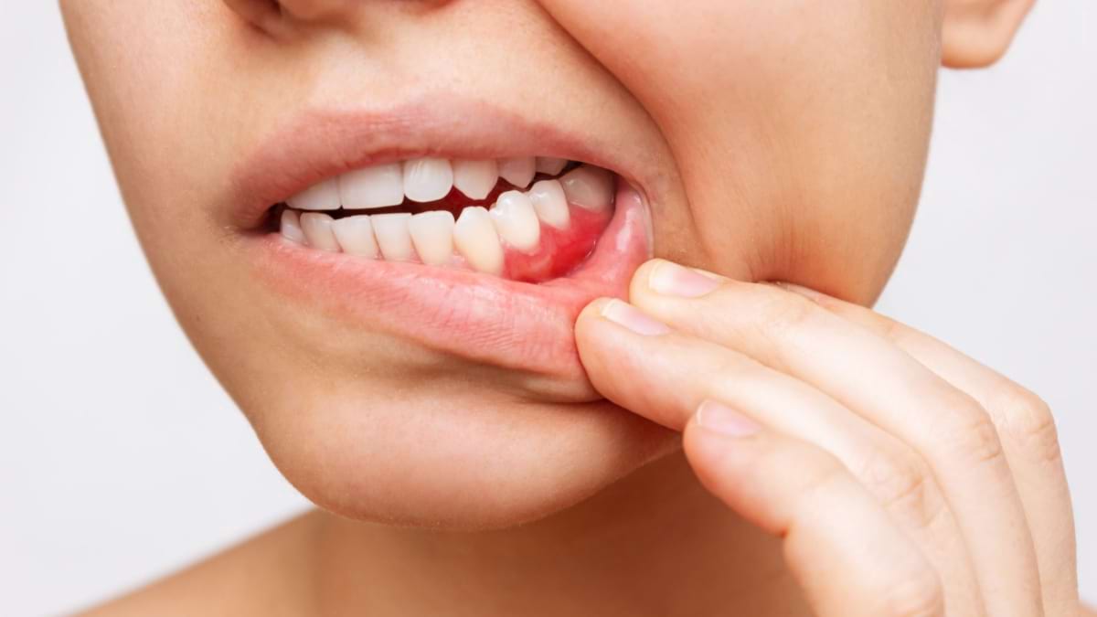 Parodontita: care sunt cele mai comune cauze ale afectării gingiilor